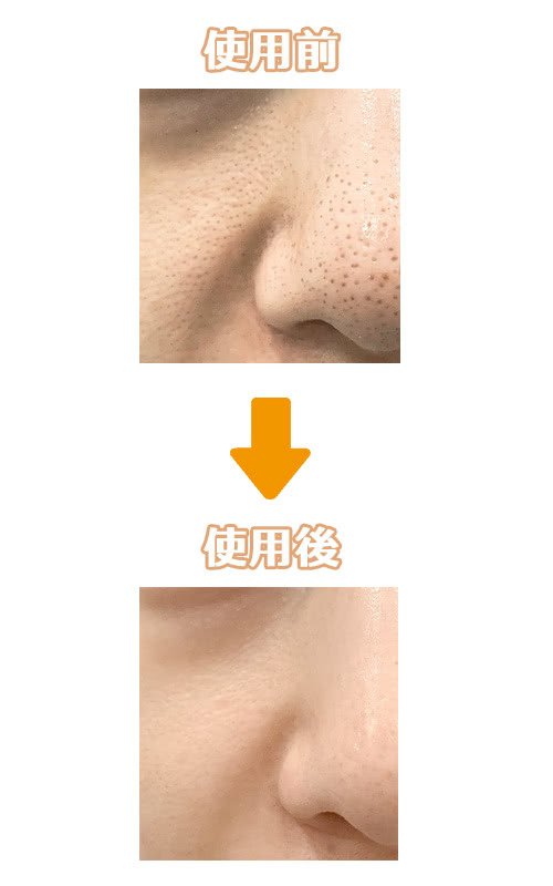 イソトレチノイン(トレティバ)の使用前後の写真