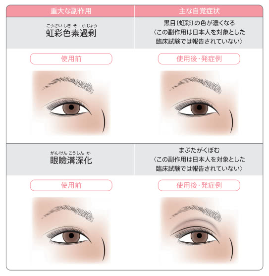 虹彩色素過剰・眼瞼溝深化